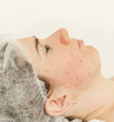 acne, Adult Acne Treatment acne, Adult Acne Treatment