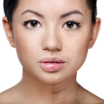 uneven skin tone