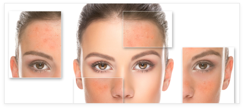 Adult Acne Treatment