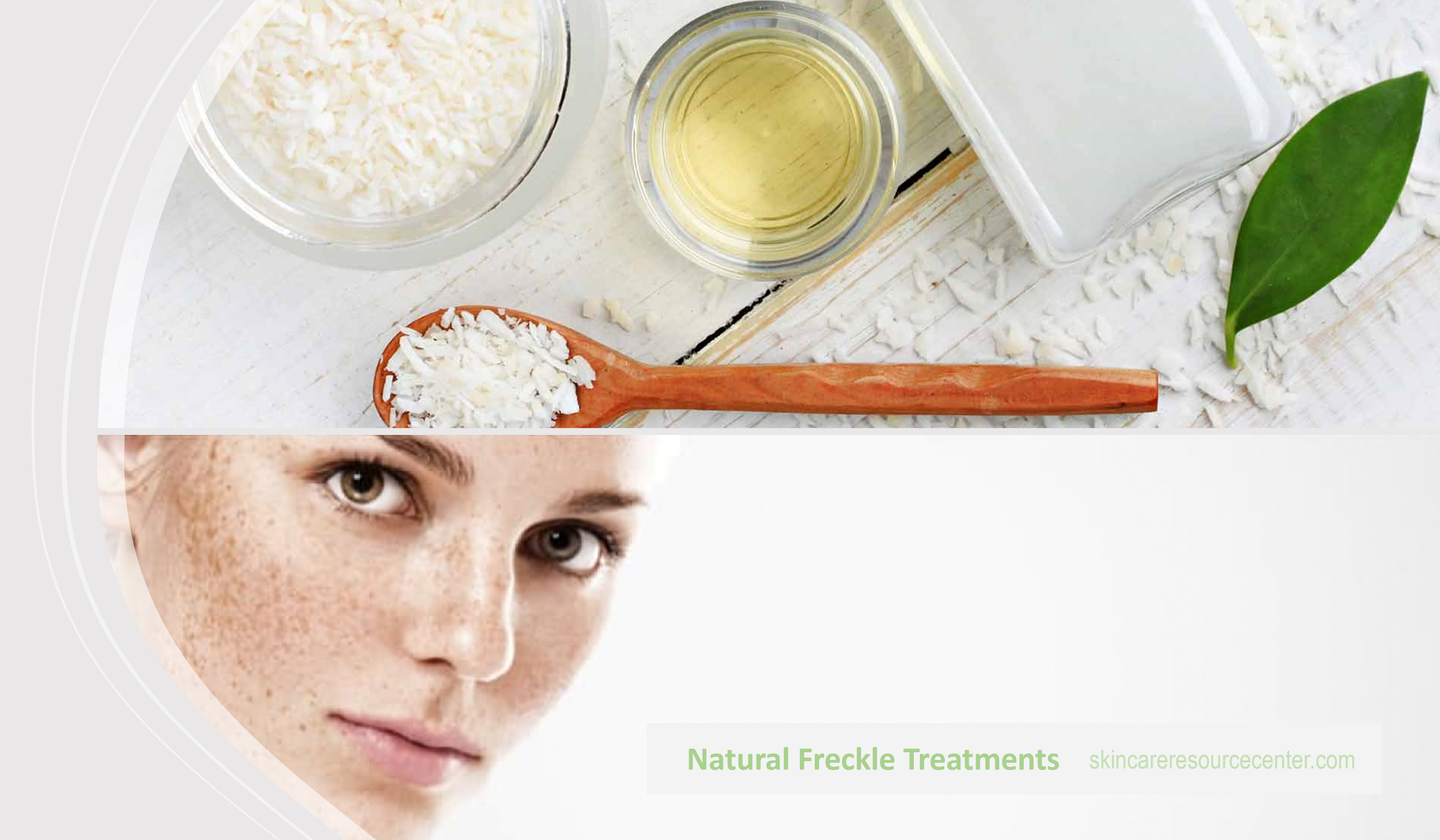 Natural Treatment for Freckles