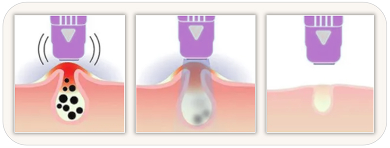 acne-clearing-device