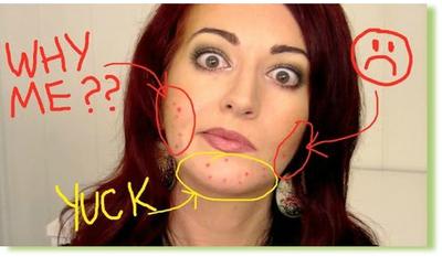 Be Proactive!  Acne Treatment that Work