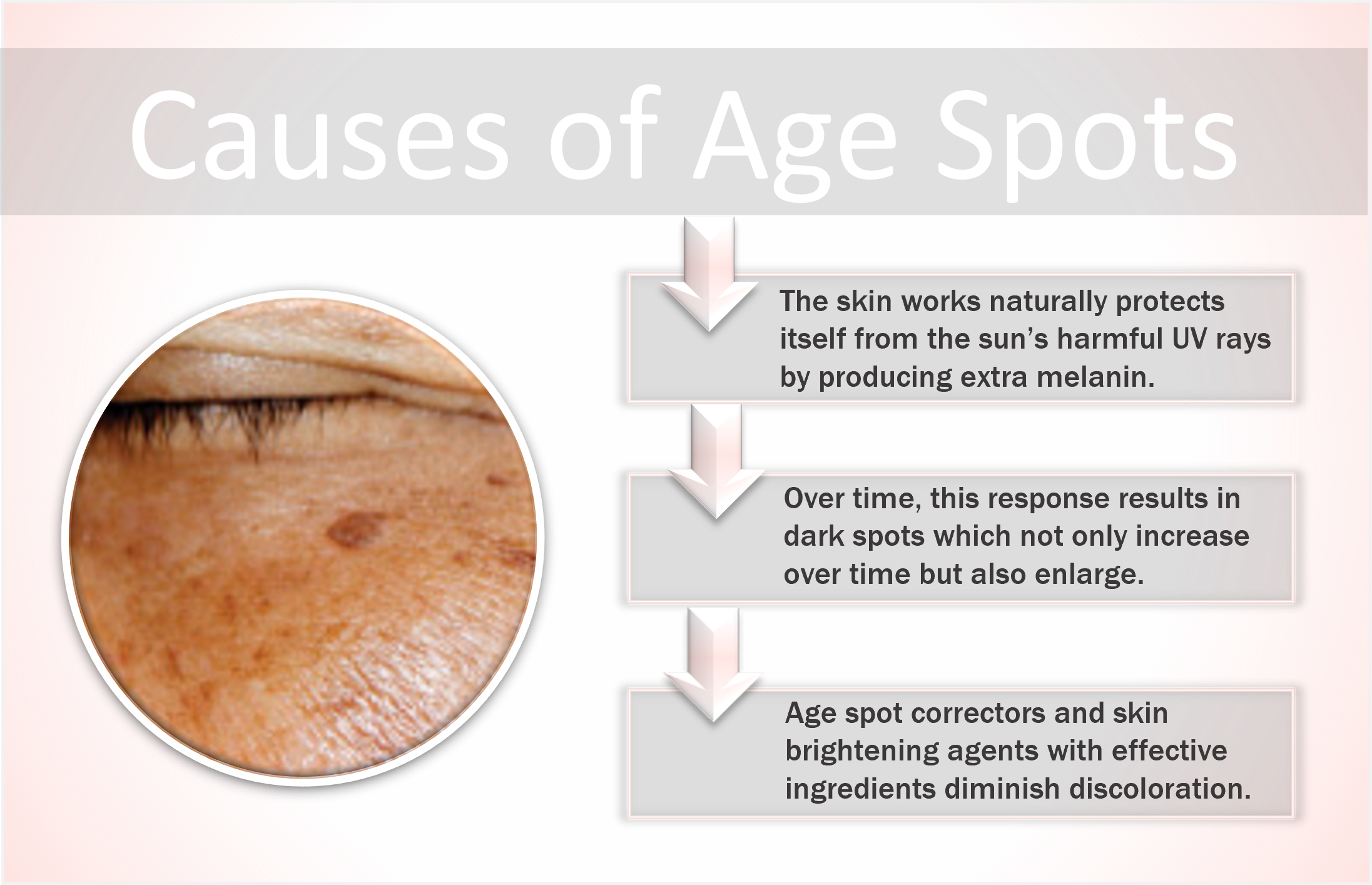 Causes of age spots