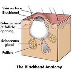 How To Remove a Blackhead