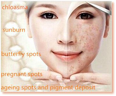 Treatments for Dark Spots on Face