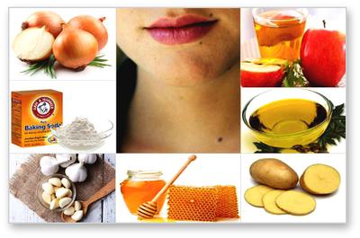 How to Remove Moles Yourself with DIY Natural Treatments