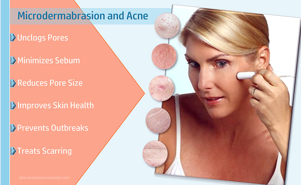 Best at Home Microdermabrasion for Acne Treatment Options