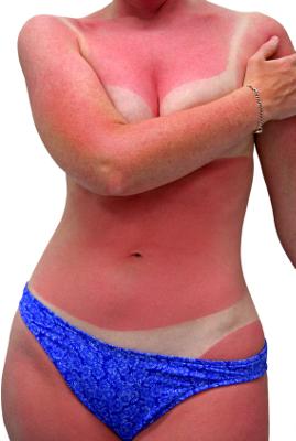 Natural Cure for Sunburn