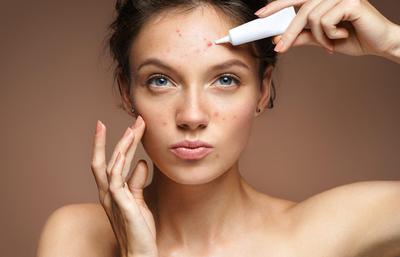 Adult Acne Treatments