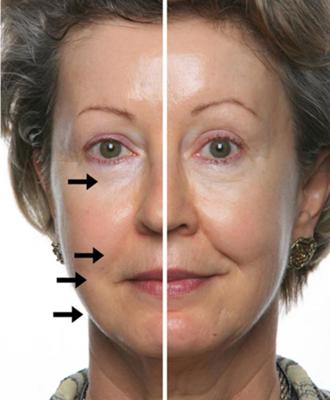 Results after just 1 treatment with the NuSkin Galvanic Spa