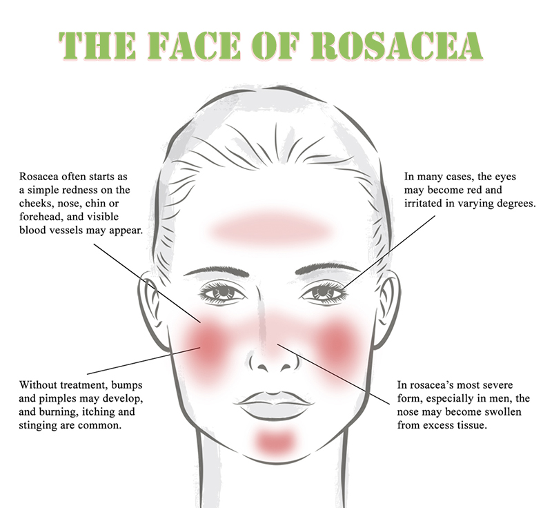 The facial symptoms of rosacea. treating-rosacea