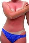 Natural Cure for Sunburn